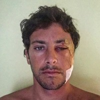 インドネシアでリーフヒットしたジェレミー・フローレス本人による事故詳細